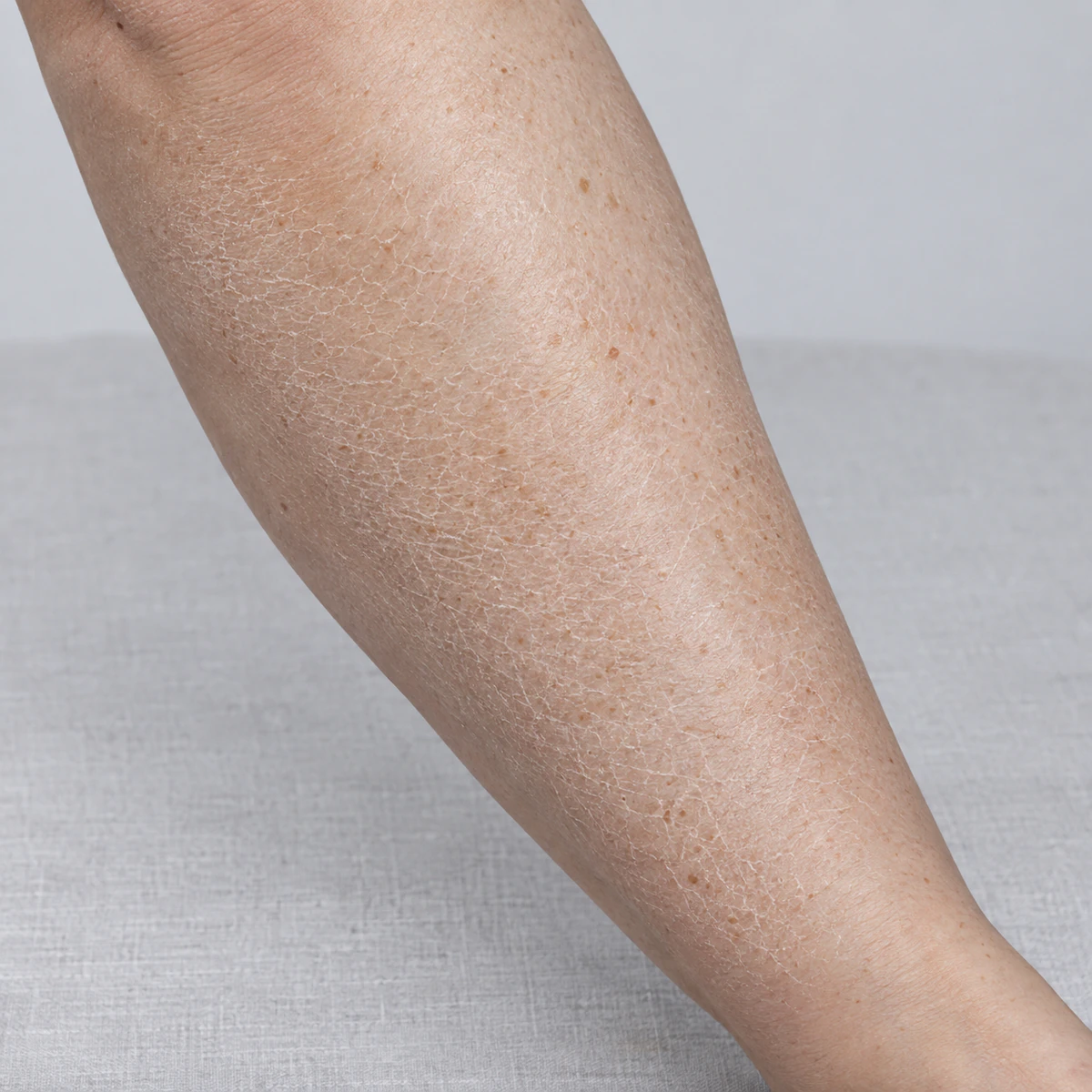 Peau sèche sur la jambe, avec des zones de sécheresse visibles